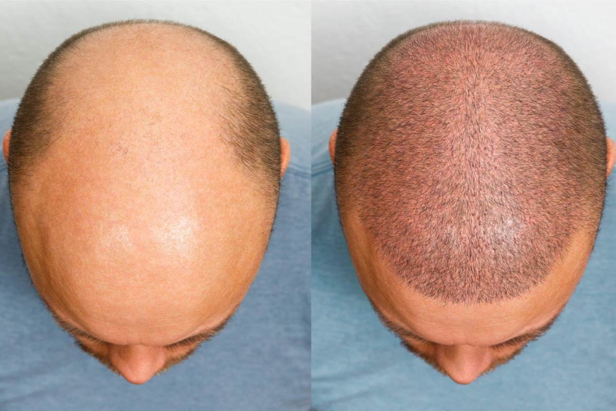 Hair Transplant Write For Us – Submit and Contribute